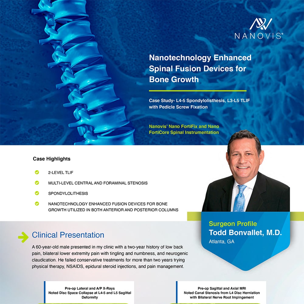 Nanotechnology Enhanced Spinal Fusion Devices for Bone Growth
