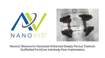 Nanosurface Technology on Spinal Interbody
